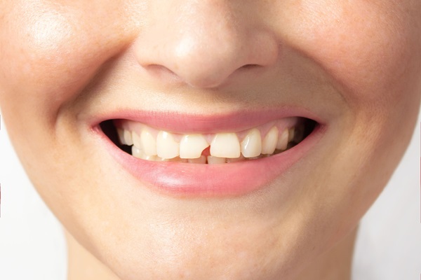 Treatment Options For A Chipped Tooth By A Cosmetic Dentist