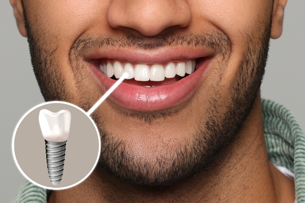 Securely Replace Teeth With Dental Implants